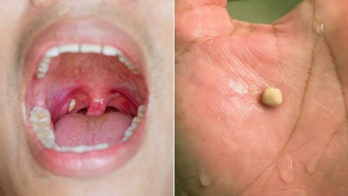 How to get tonsil stones out?