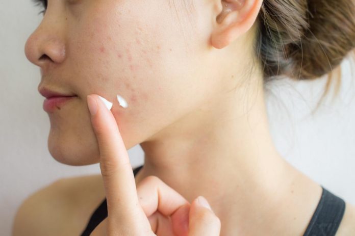 How to remove pimple marks?
